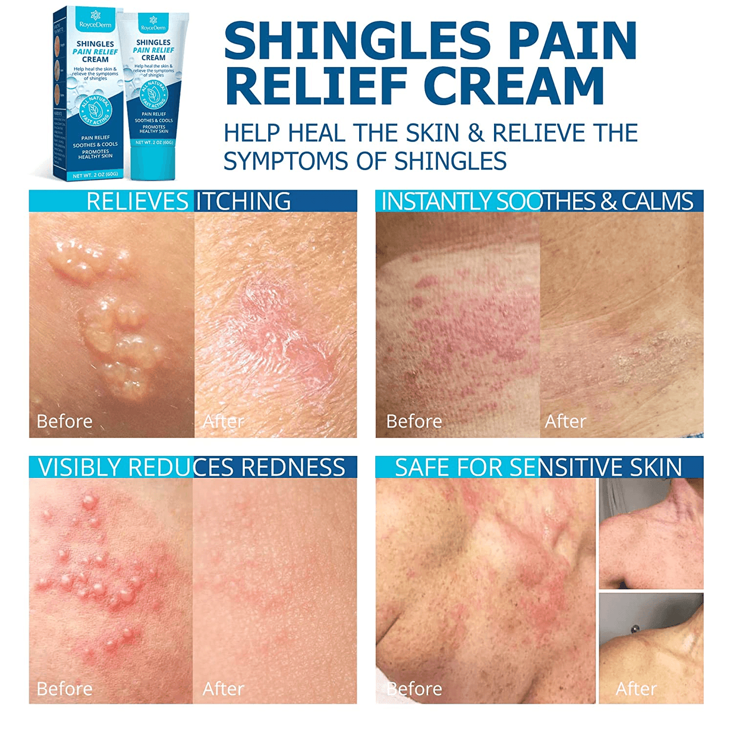 Shingles Pain Relief Cream
