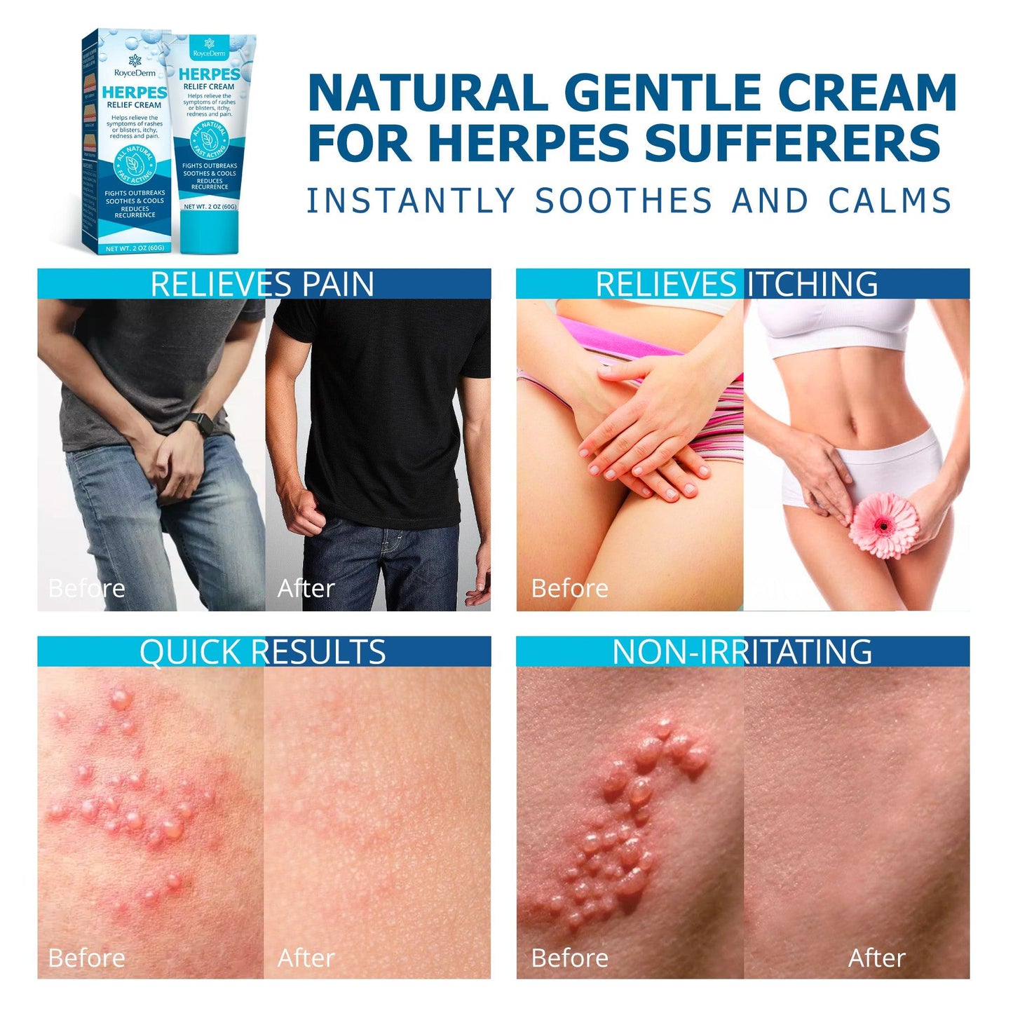 Herpe Treatment Cream