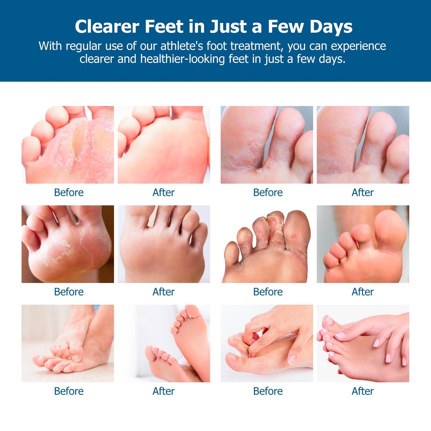 Athlete’s Foot Cream