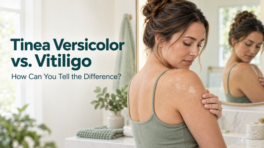 Woman examining light skin patches while comparing tinea versicolor and vitiligo