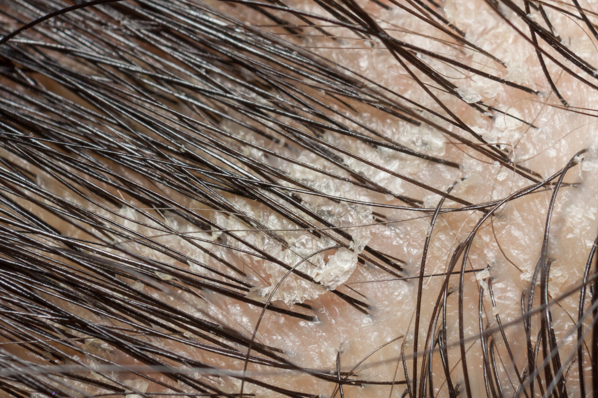 scalp with flakes and dandruff