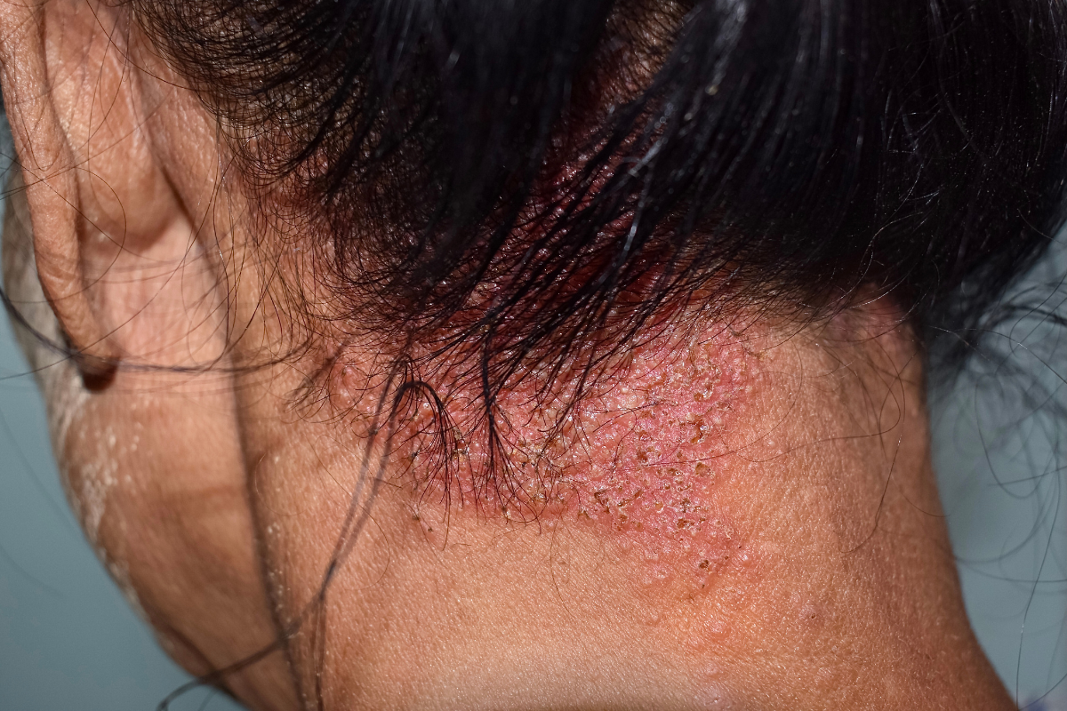 Neck with Seborrheic Dermatitis & Psoriasis, Inflammation