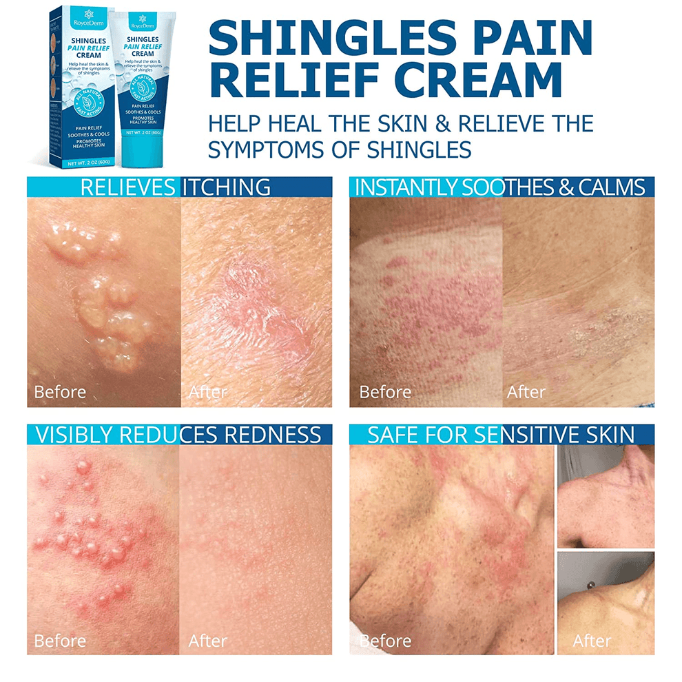 Shingles Pain Relief Cream Roycederm shingles-pain-relief-cream-roycederm