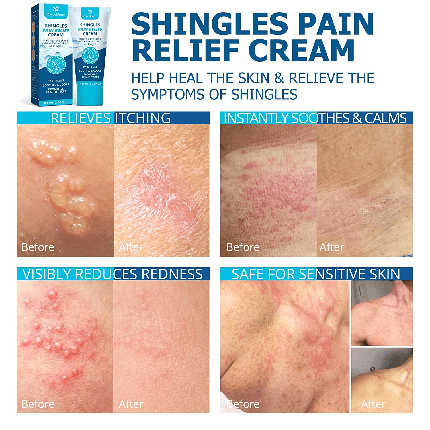 Shingles Treatment Shingles Treatment And Prevention Primary Care In Shingles Treatment Shingles Treatment And Prevention Primary Care In
