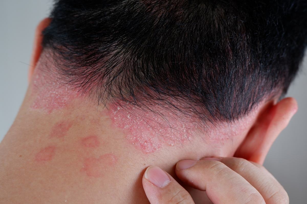 Imflamed, Itchy Neck, Seborrheic Dermatitis & Psoriasis