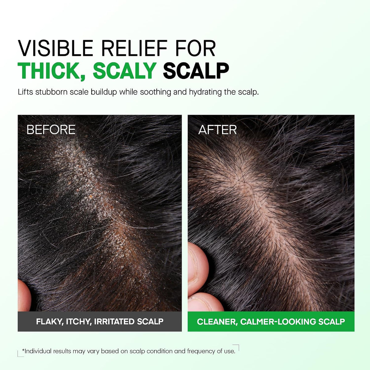 Scalp Psoriasis Treatment Spray