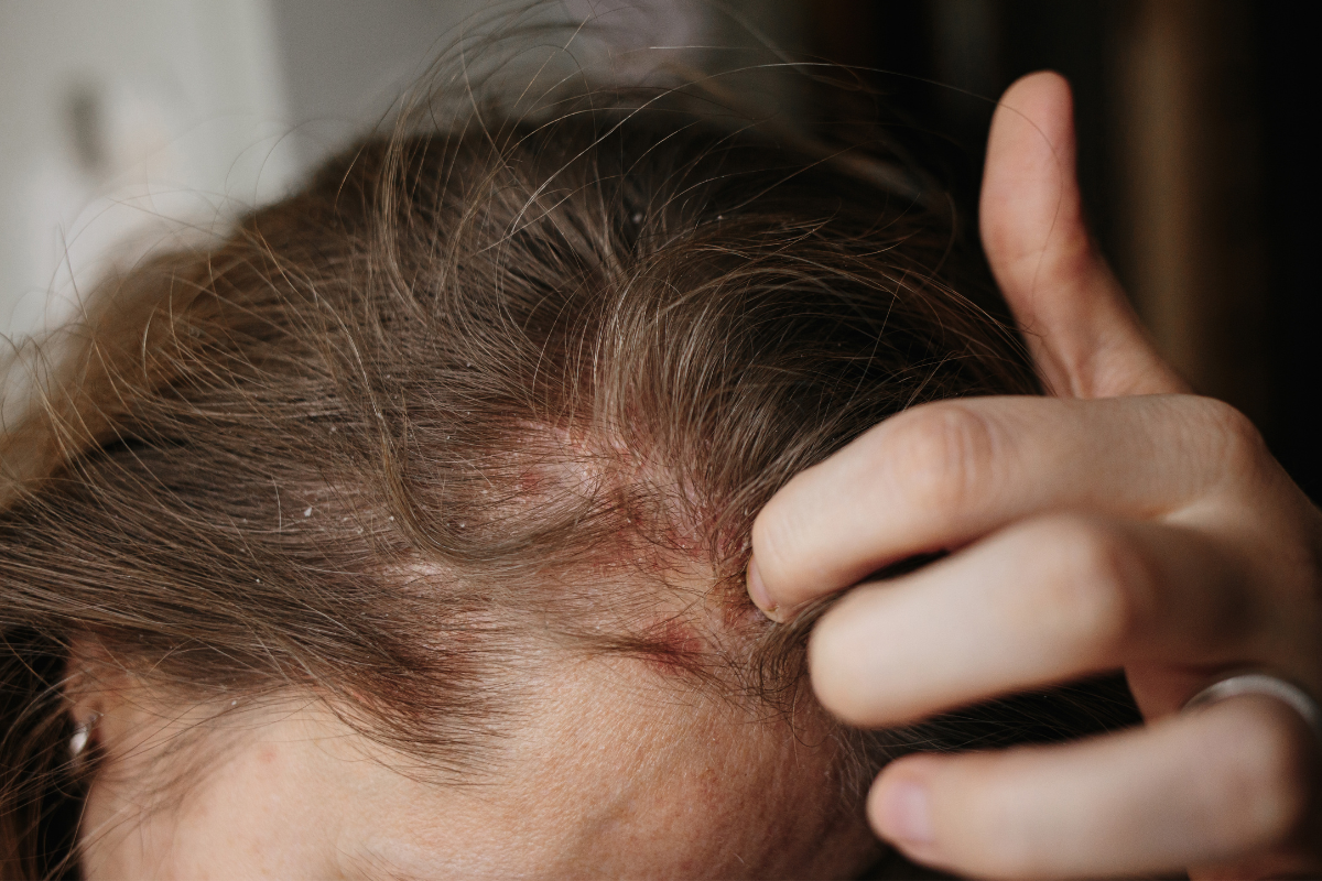 Dry, itchy, inflamed scalp
