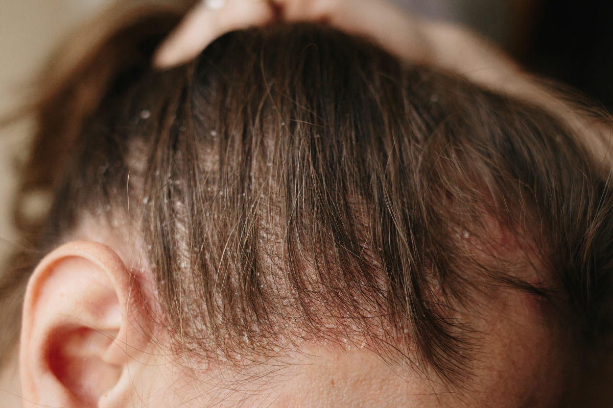 scalp with flakes