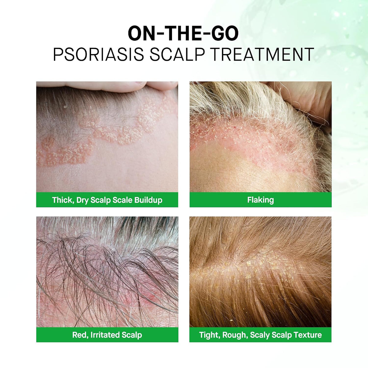 Scalp Psoriasis Treatment Spray