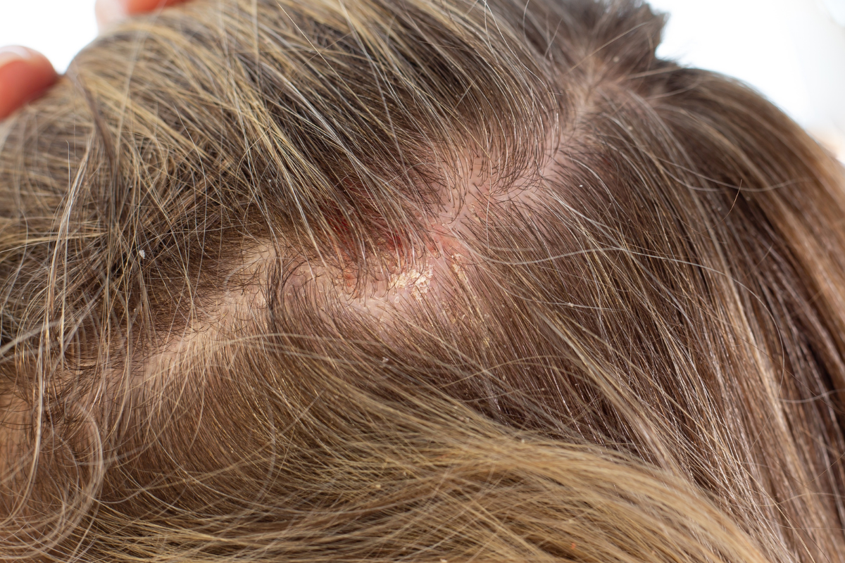 Dry, Inflamed Scalp