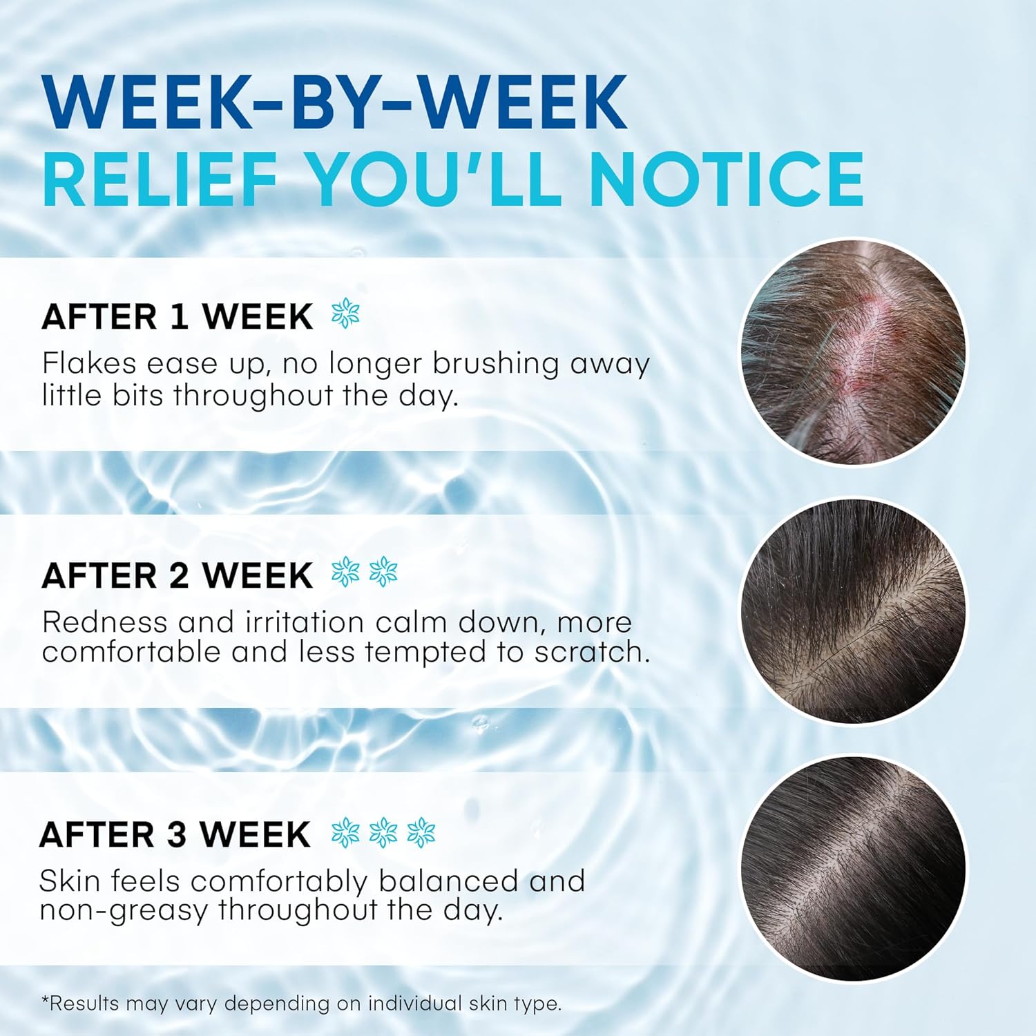Week-by-week results of Roycederm Calming Serum show reduced flakes, redness, and improved skin balance after 1 to 3 weeks of use.