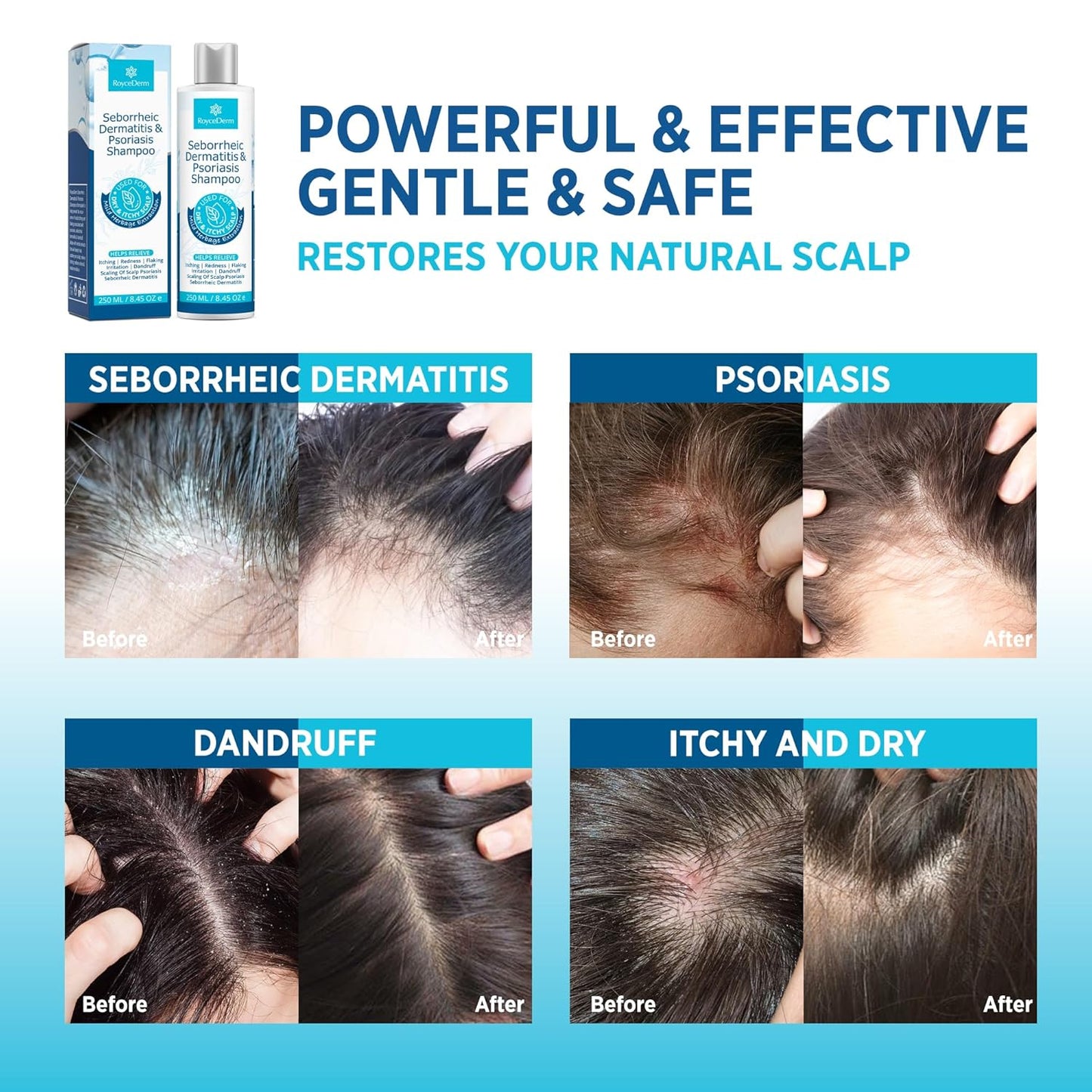 Seborrheic Dermatitis & Psoriasis Cream, Shampoo and Conditioner Set