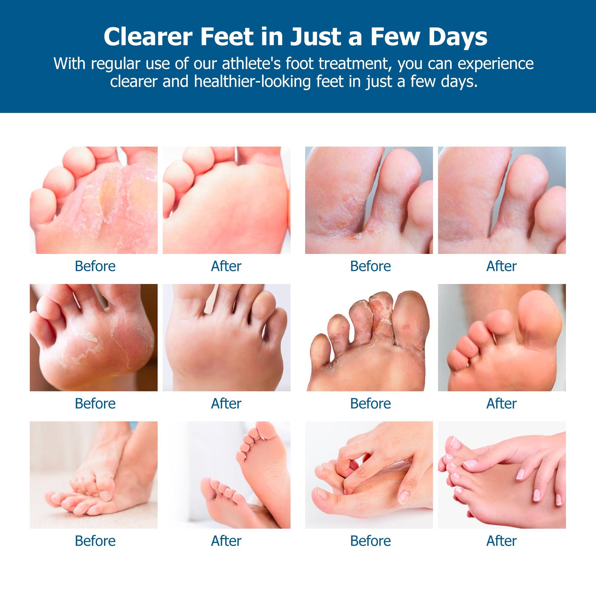 Athlete’s Foot Cream