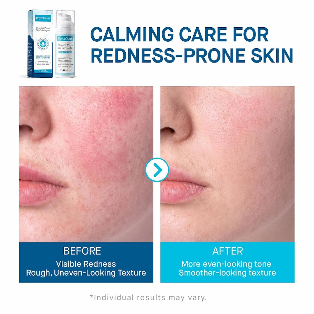 Rosacea-Prone Skin Calming Gel